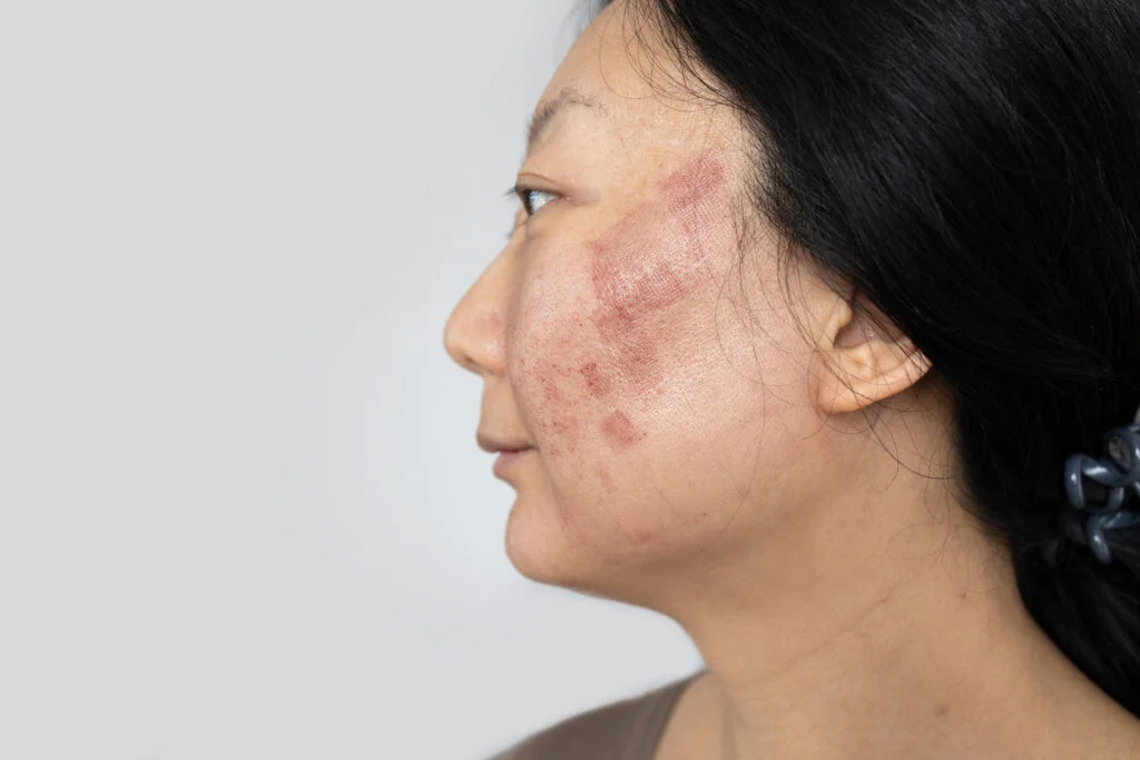 Skin Clinic 1 a face of asian woman who had facial skin treatmen 2024 03 04 19 50 03 utc