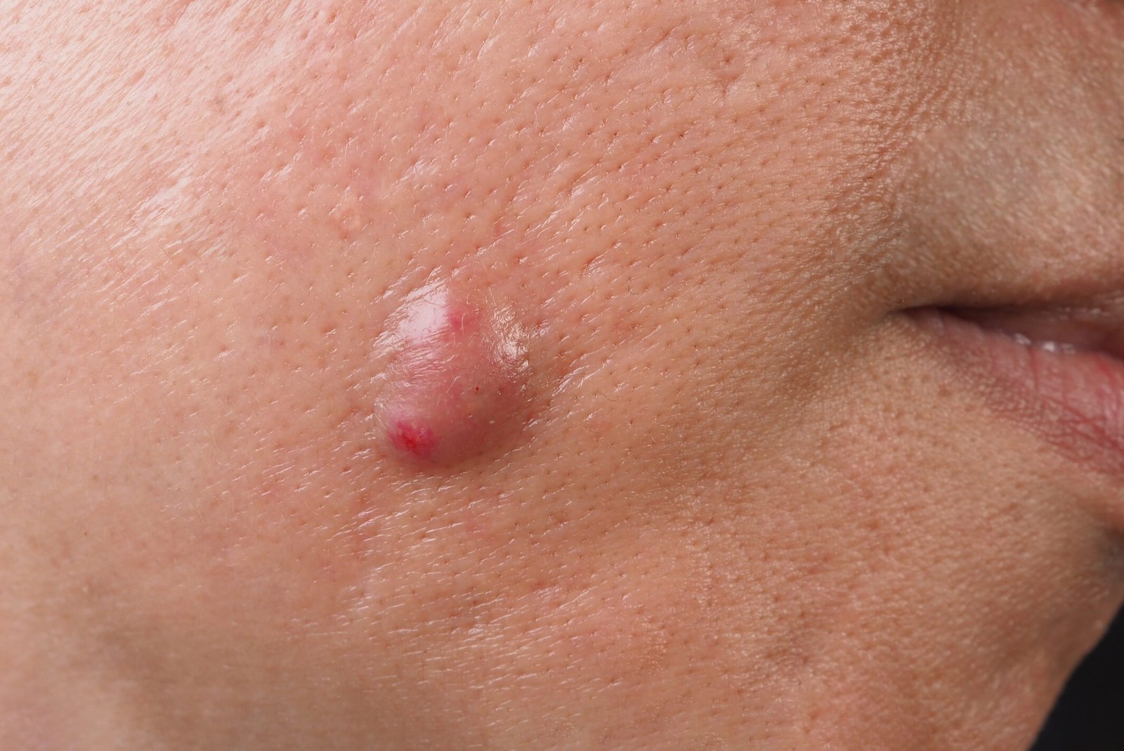 big acne cyst abscess or ulcer swollen area within 2023 11 27 05 10 00 utc scaled e1728530730915