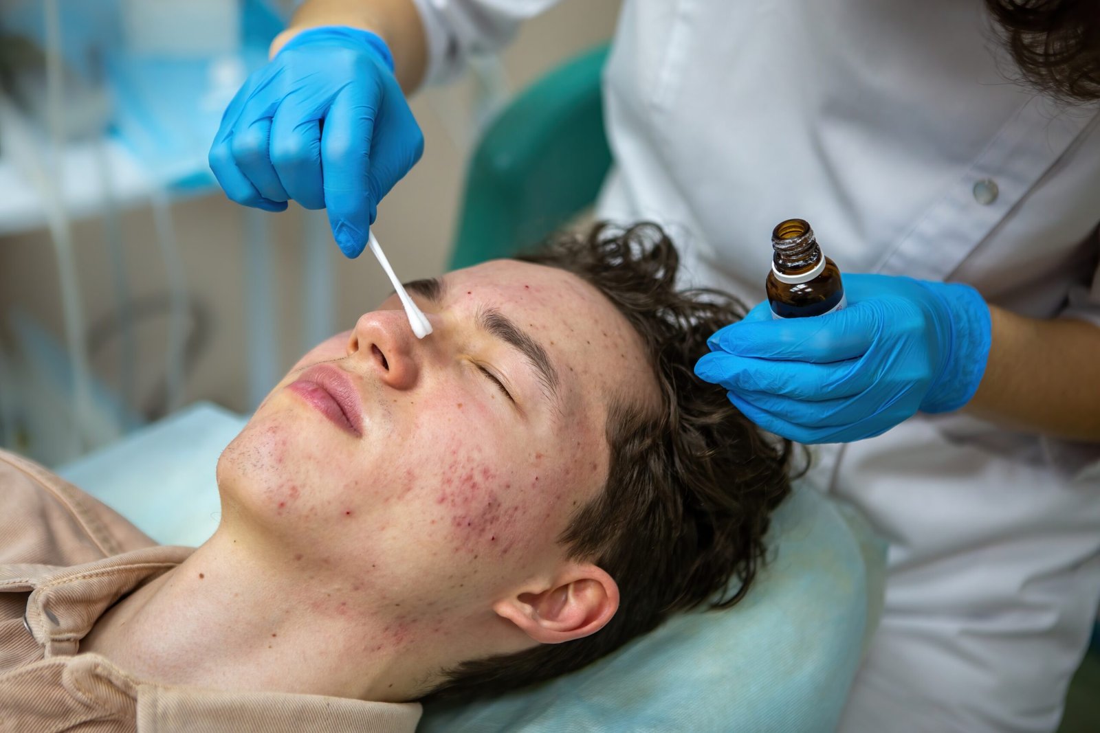 treatment of acne in adolescents facial peeling t 2023 11 27 05 19 37 utc scaled