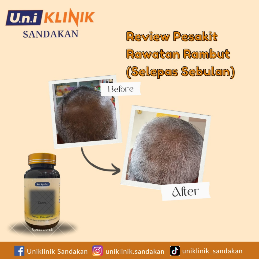hair loss treatment before and after
