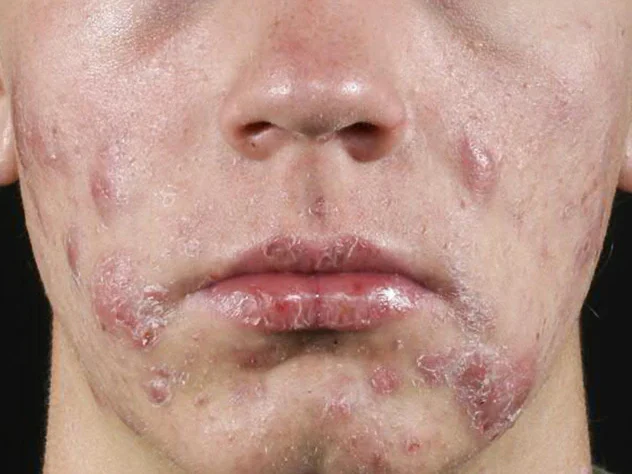 Skin Clinic 4 47 cysticacne 8col e1740366863569