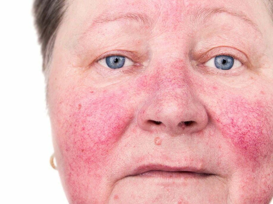 Skin Clinic 8 5 Things to Know About Rosacea in Honor of Rosacea Awareness Month e1740367162692