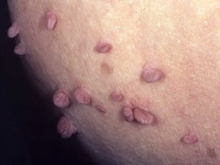 Skin Clinic 14 5038 skin tags 1296x728 slide1 e1740367421471