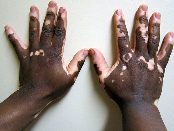 Skin Clinic 7 640px Vitiligo2 e1740367150185