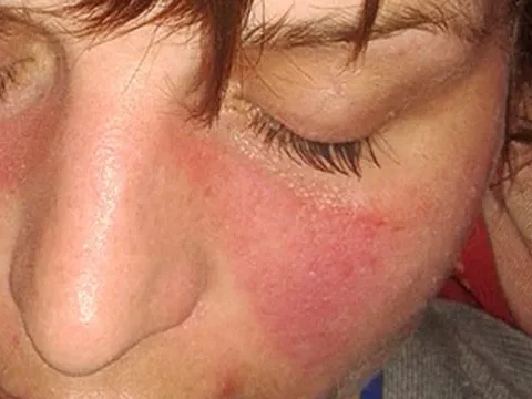 Skin Clinic 9 642X361 SLIDE 2 Systemic Lupus Erythematosus e1740367175822
