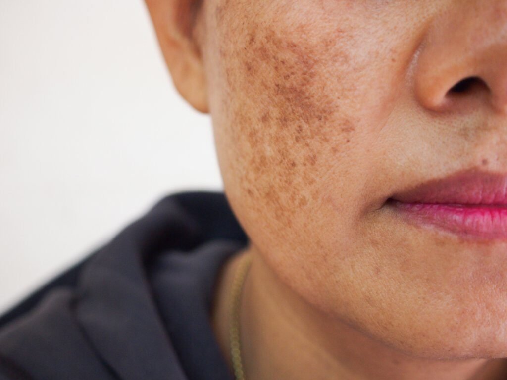 Skin Clinic 11 Melasma01 e1740367198399