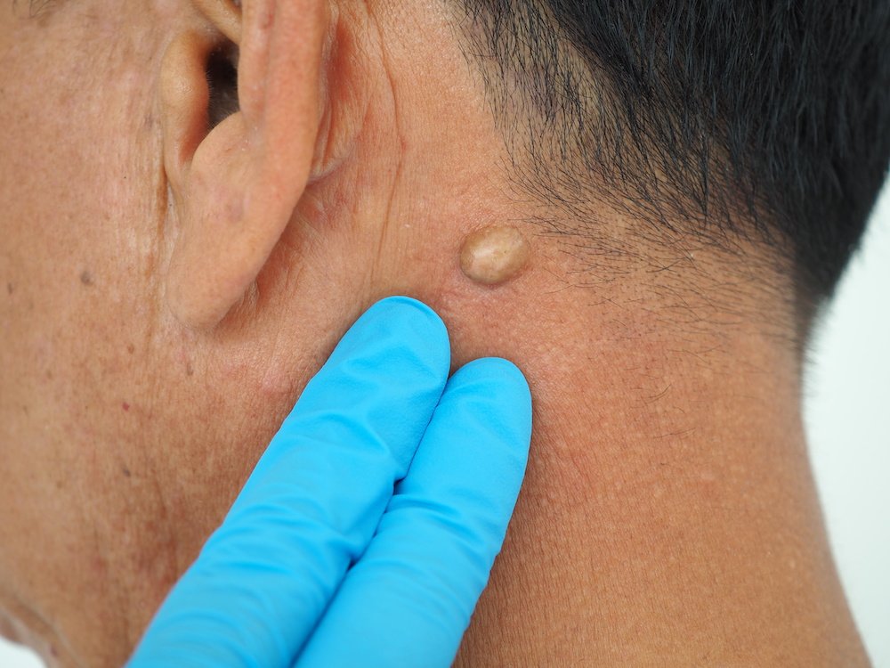 Skin Clinic 13 sebacous cyst