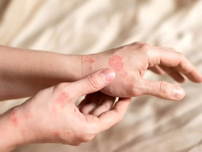 Skin Clinic 2 types of eczema e1740366852221