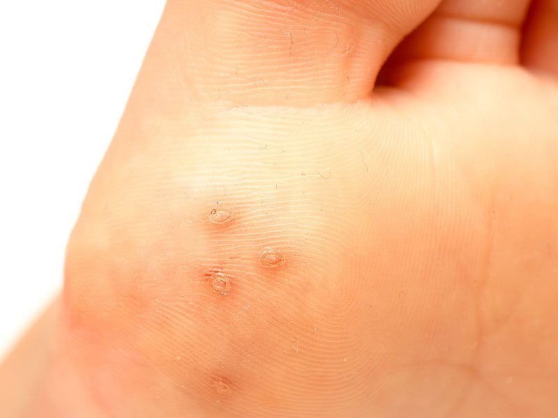 Skin Clinic 15 warts e1740367438185