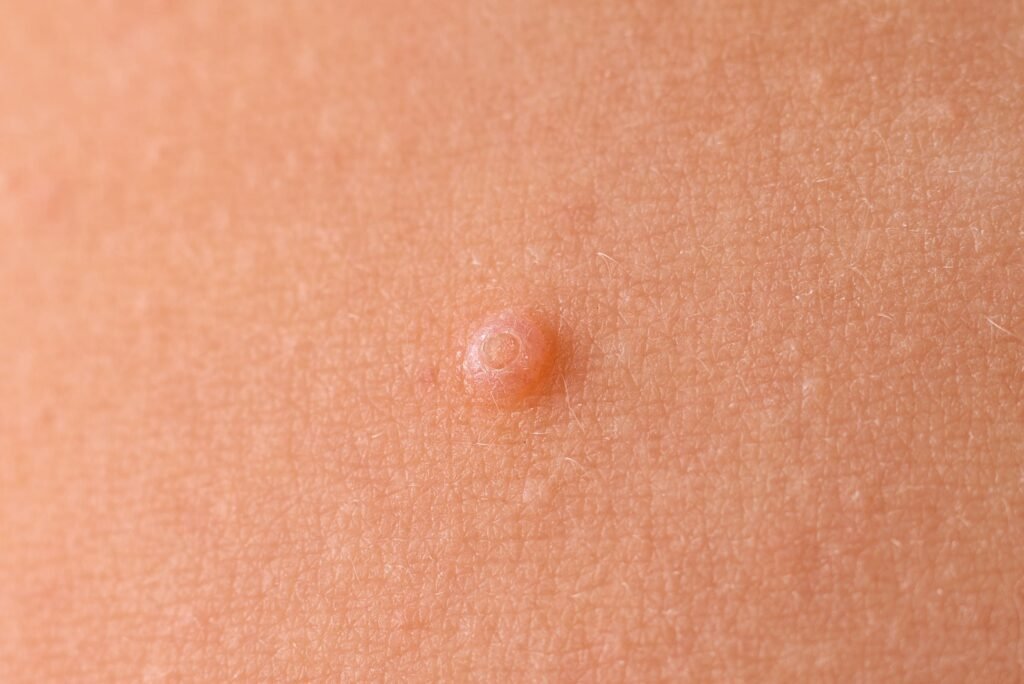 Lipoma Treatment in Sandakan, Sabah | U.n.i Klinik Sandakan