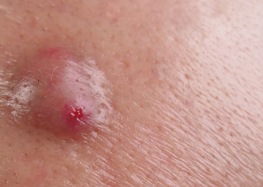 Cyst Removal in Sandakan, Sabah | U.n.i Klinik Sandakan