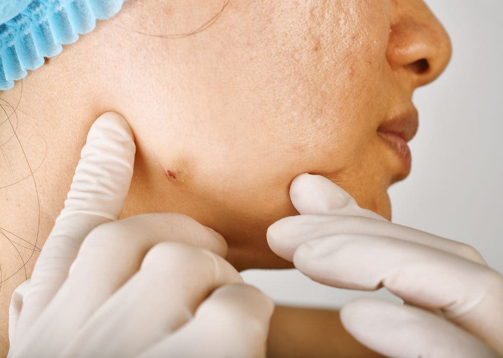Cyst Removal in Sandakan, Sabah | U.n.i Klinik Sandakan