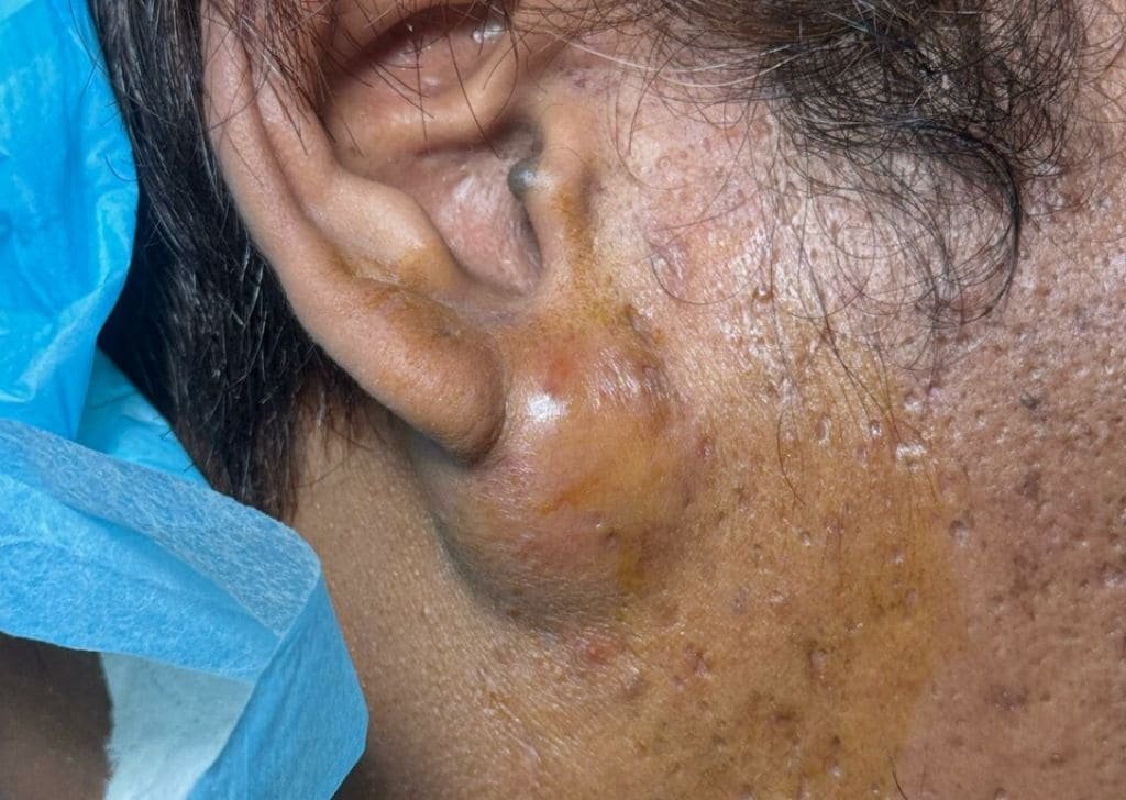 Cyst Removal in Sandakan, Sabah | U.n.i Klinik Sandakan