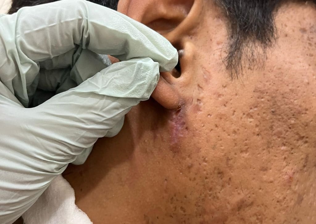 Cyst Removal in Sandakan, Sabah | U.n.i Klinik Sandakan
