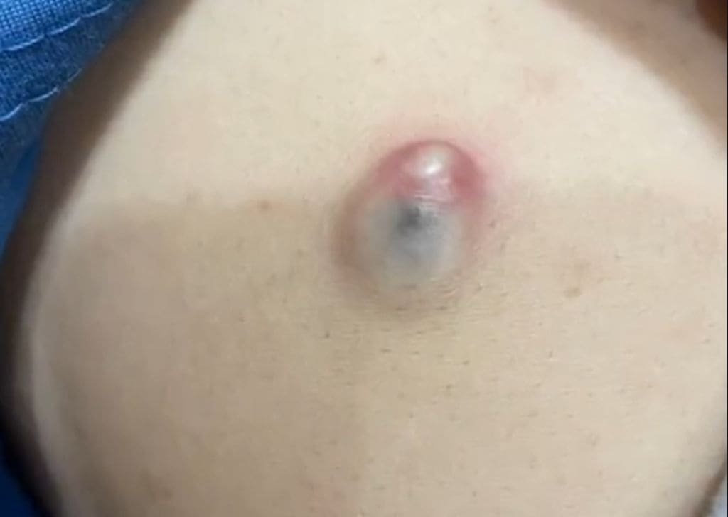 Cyst Removal in Sandakan, Sabah | U.n.i Klinik Sandakan