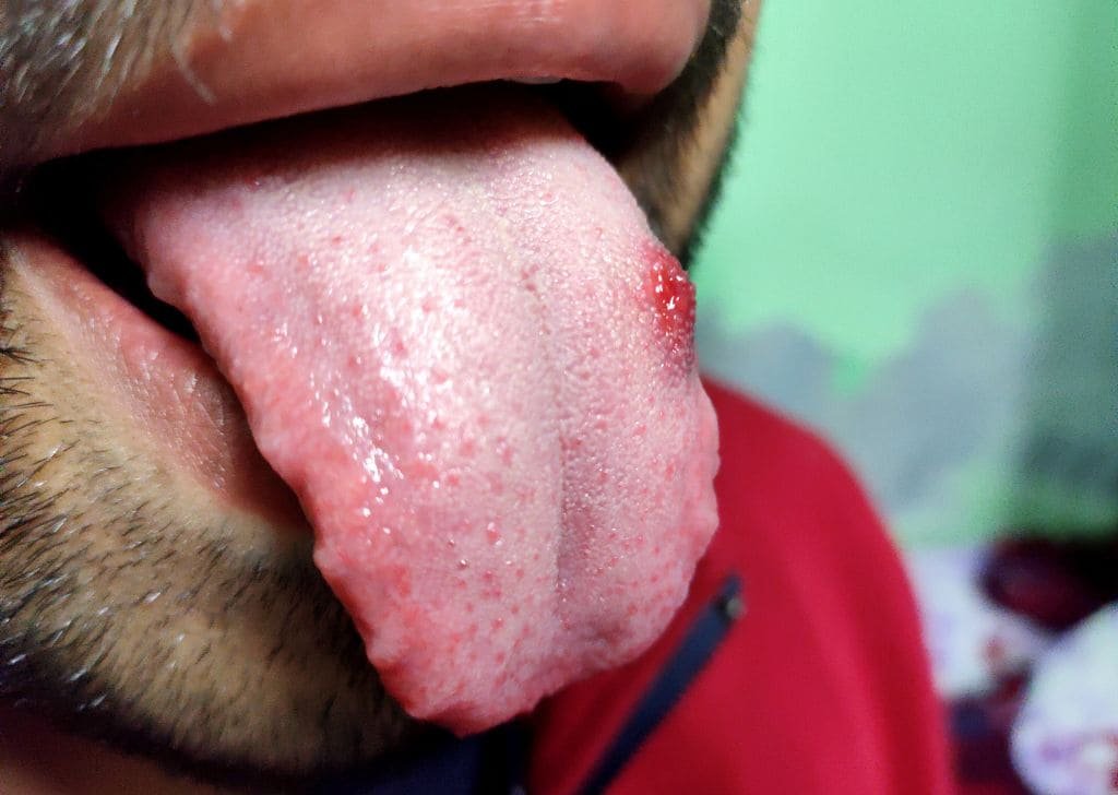 Cyst Removal in Sandakan, Sabah | U.n.i Klinik Sandakan