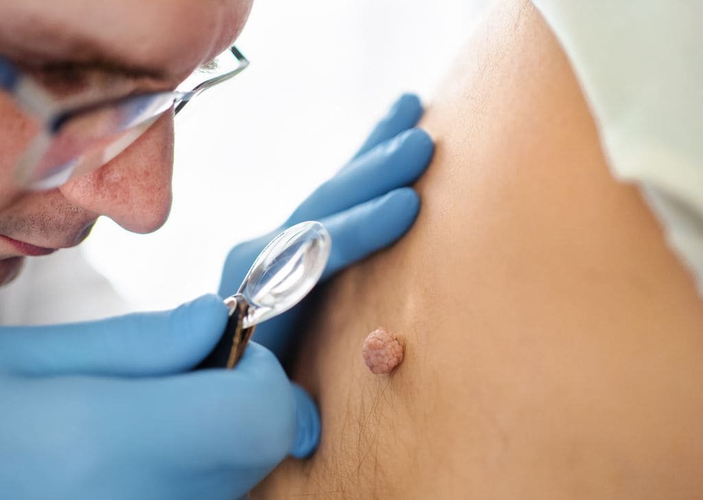 Skin tag removal at a klinik pakar kulit in Sandakan.