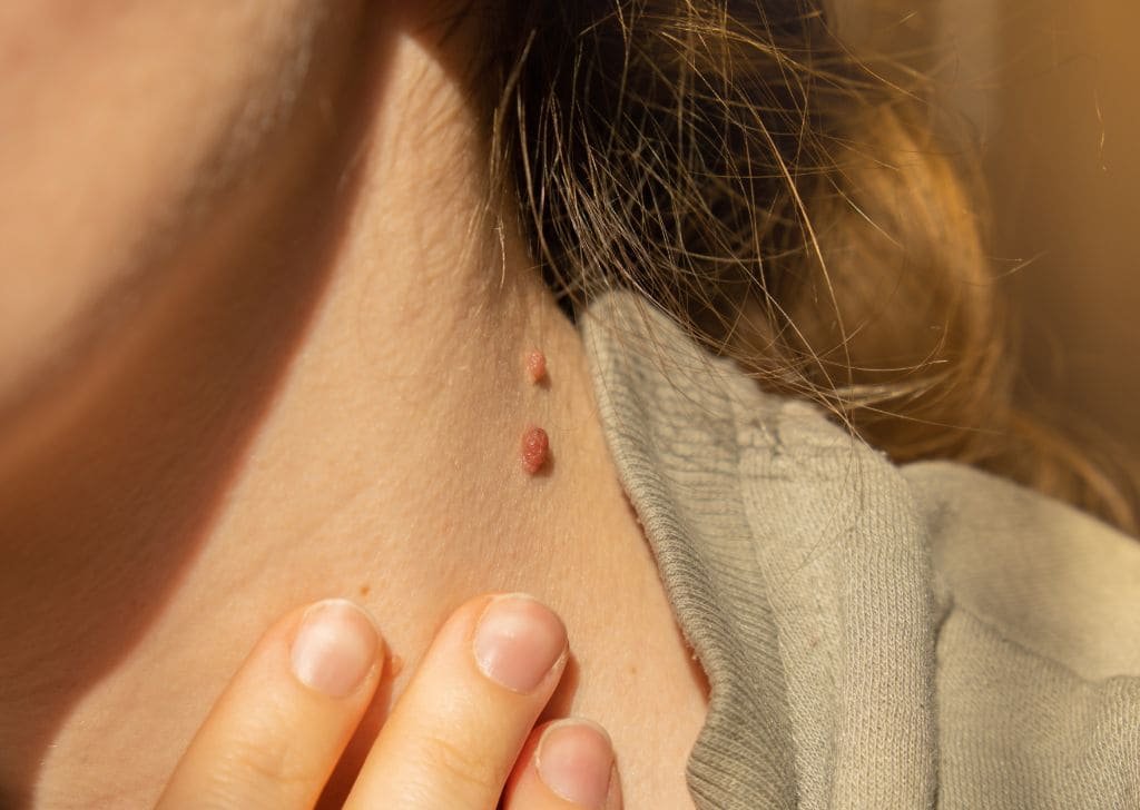 Skin tag removal at a klinik pakar kulit in Sandakan.