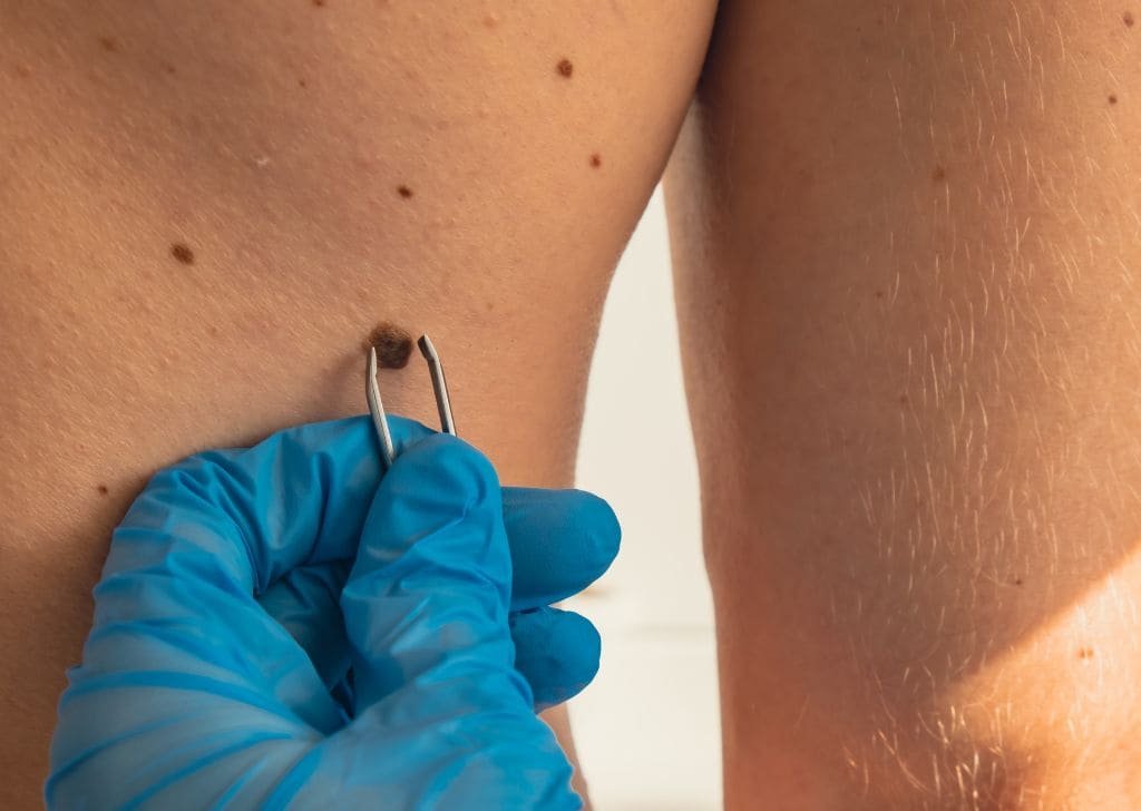 Skin tag removal at a klinik pakar kulit in Sandakan.