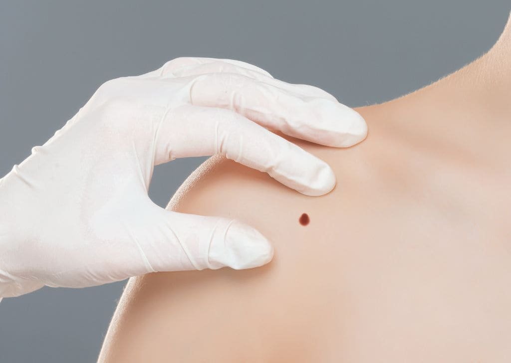 Skin tag removal at a klinik pakar kulit in Sandakan.