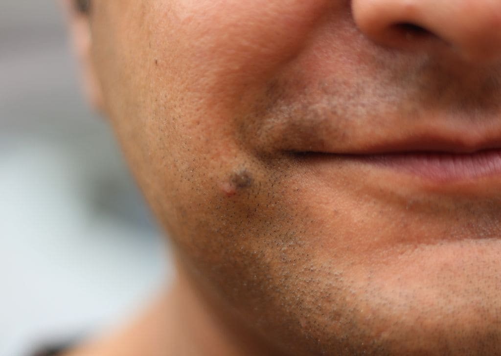 Skin tag removal at a klinik pakar kulit in Sandakan.