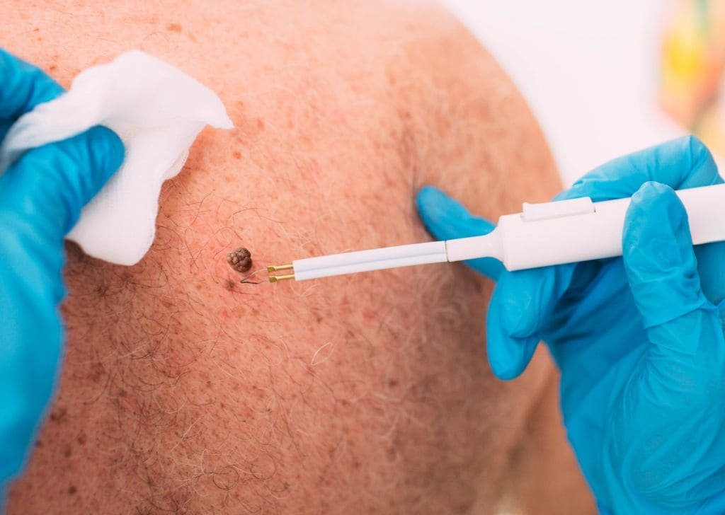 Skin tag removal at a klinik pakar kulit in Sandakan.