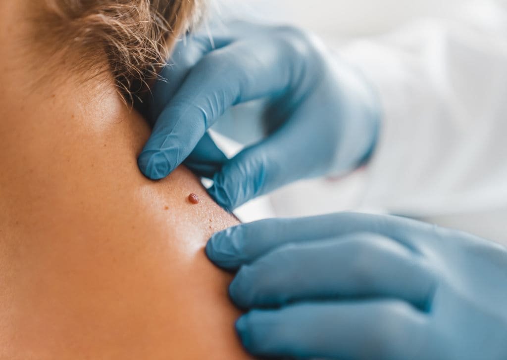 Skin tag removal at a klinik pakar kulit in Sandakan.