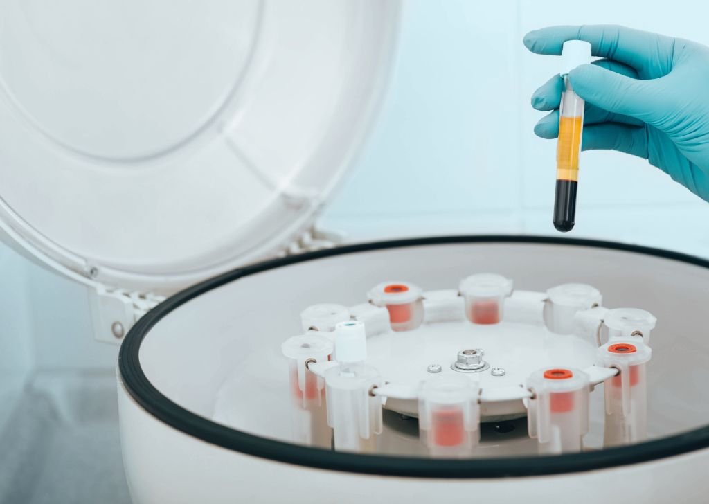 A vial of platelet-rich plasma (PRP) being prepared as an intra articular injection.