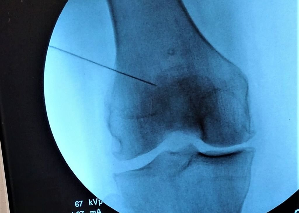 An intra articular injection needle inside a patient's knee under an x-ray scan.