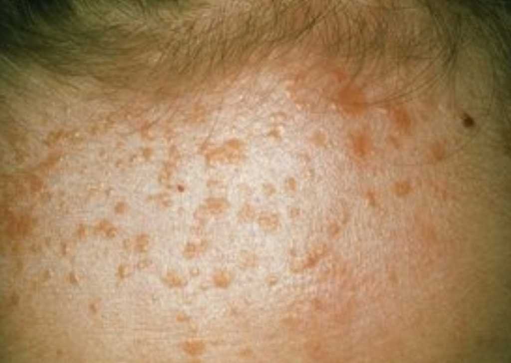 Common warts have a rough texture and often appear on hands, elbows, or knees. Flat warts are smoother, smaller, and may spread quickly, especially on the face and hands.
