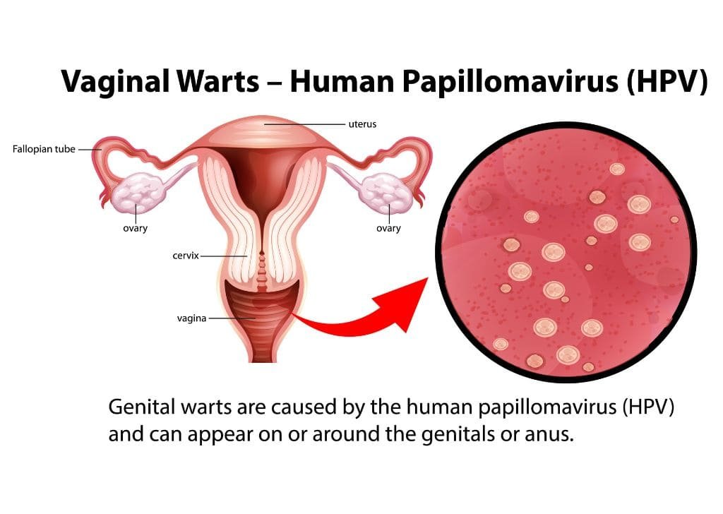 An info-graphic about genital warts caused by HPV virus.