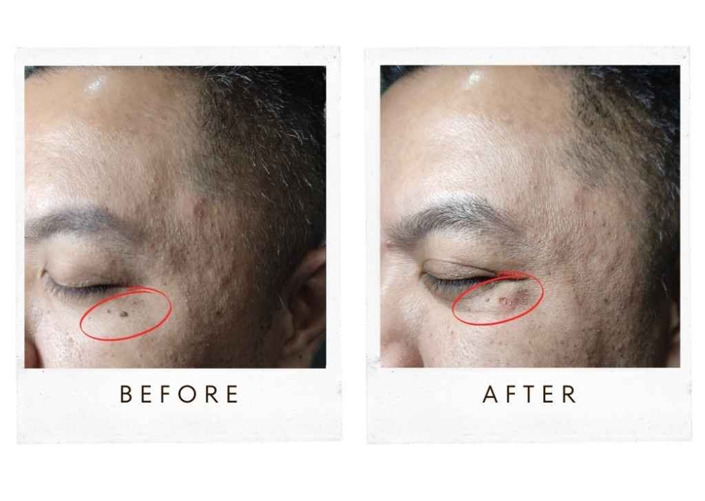 At U.n.i Klinik Sandakan, we offer effective, medically supervised treatments designed to remove warts safely and reduce the chance of recurrence.