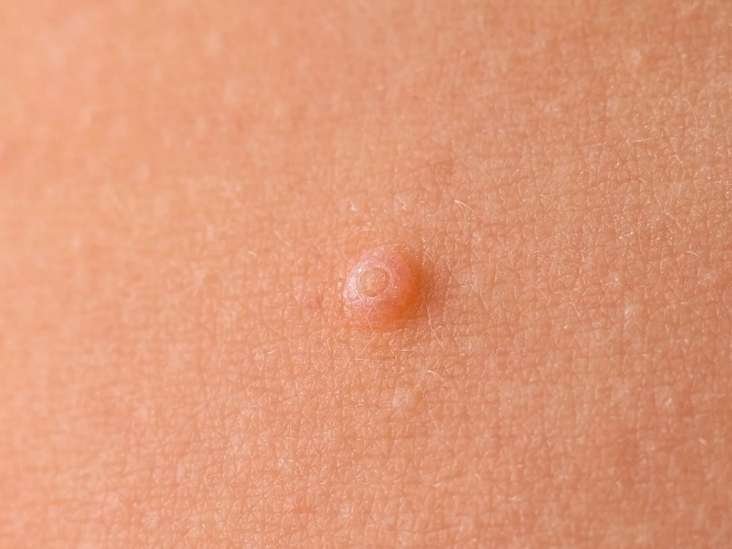 Lipoma Treatment in Sandakan, Sabah | U.n.i Klinik Sandakan