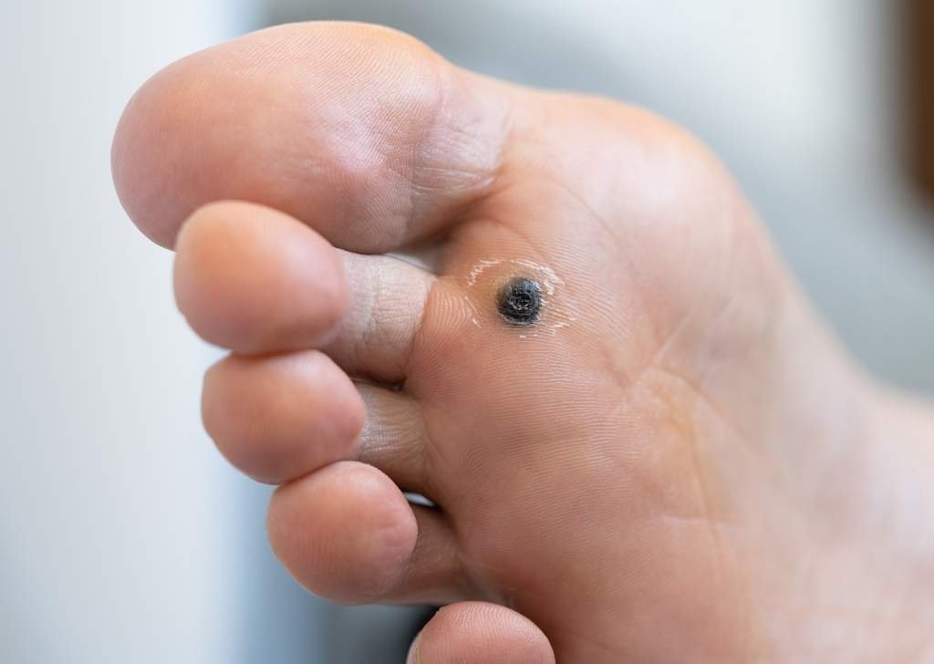 Safe, doctor-led warts removal treatments in Sandakan, Sabah. Treat plantar, facial, and common warts effectively with advanced methods at U.n.i Klinik.