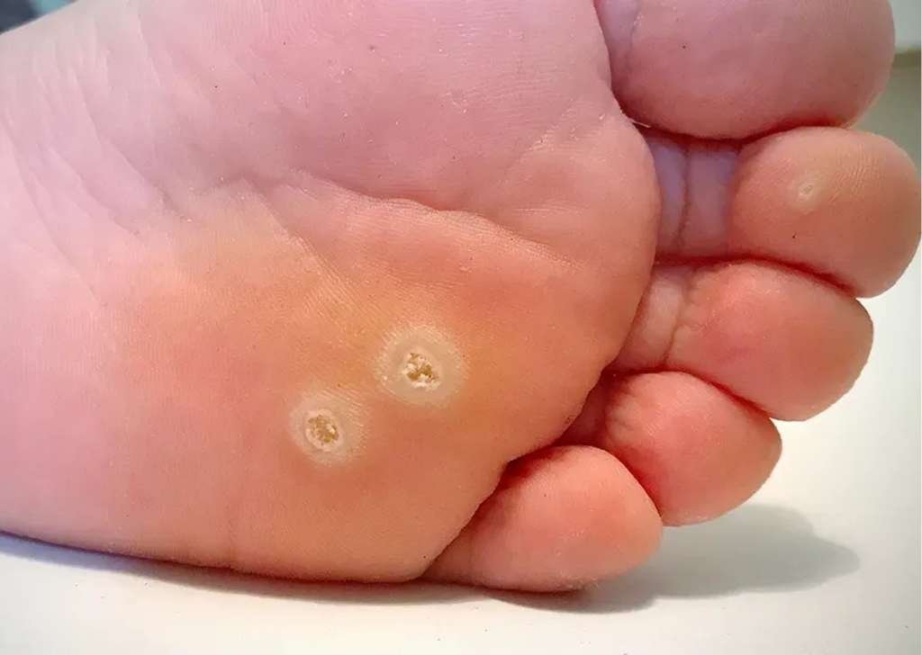 Found on the soles of the feet, plantar warts grow inward due to pressure from walking. 