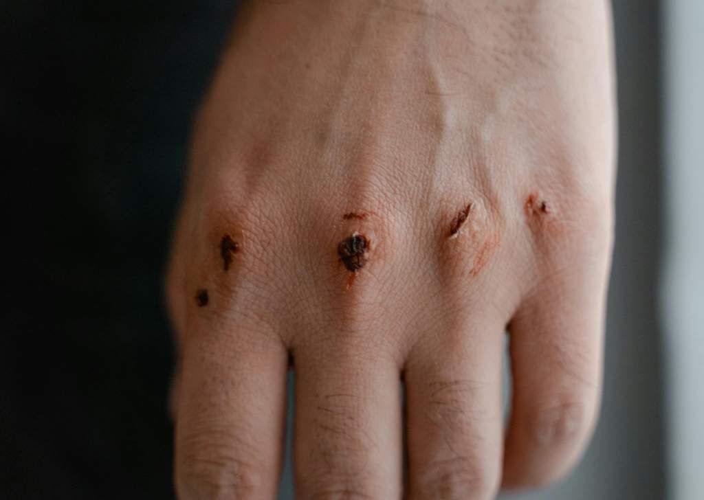 Can broken skin cause warts? Learn more here.
