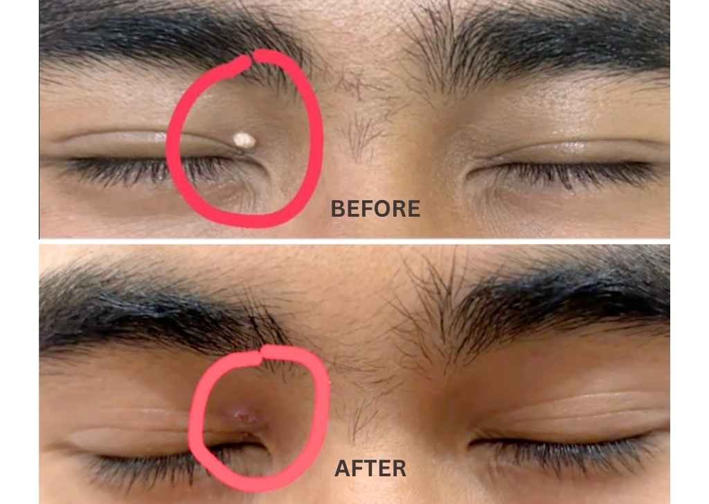 At U.n.i Klinik Sandakan, wart removal is a straightforward process. Here's a quick overview of what happens at each stage.