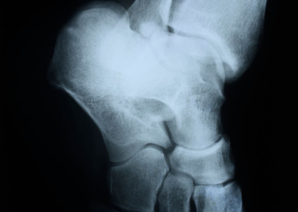 An advanced x-ray taken from a patient. Referrals are necessary for advanced joint pain treatment.