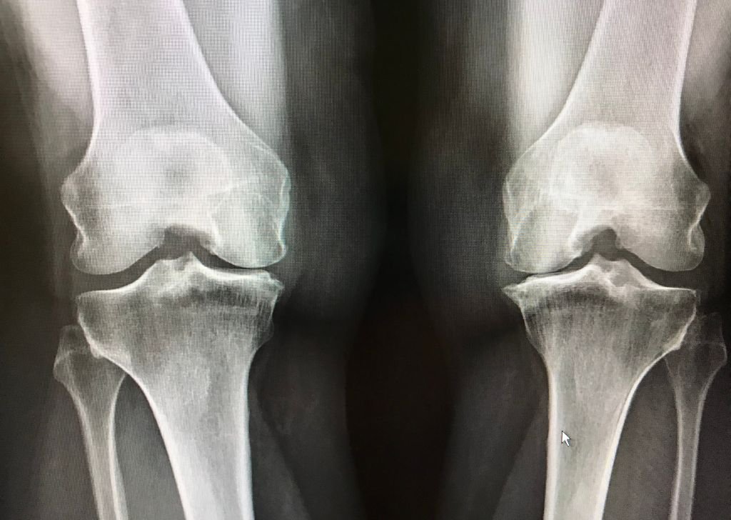 Osteoarthritis (OA) is a common form of joint pain that requires treatment.