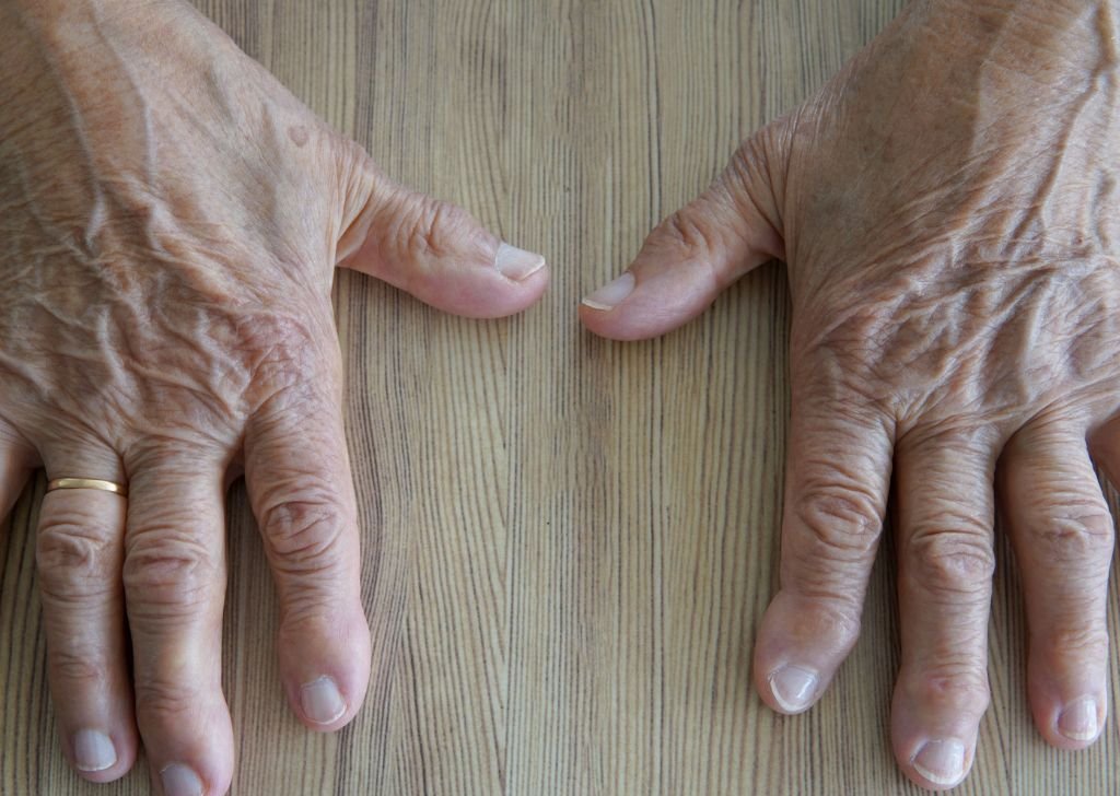 A patient having joint pain in the fingers that requires treatment. Possibly arthritis.