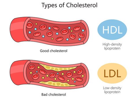 Mounjaro for Weight Loss in Sandakan 17 LDL cholesterol
