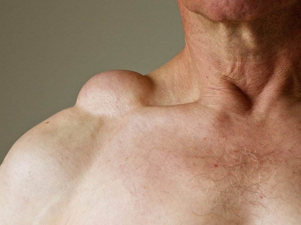 A lipoma on a male’s shoulder. A lipoma is a benign tumour, or fatty lump, consisting of soft tissue, and is non-malignant. A lipoma on a male's shoulder. A lipoma is a benign tumour, or fatty lump, consisting of soft tissue, and is non-malignant.